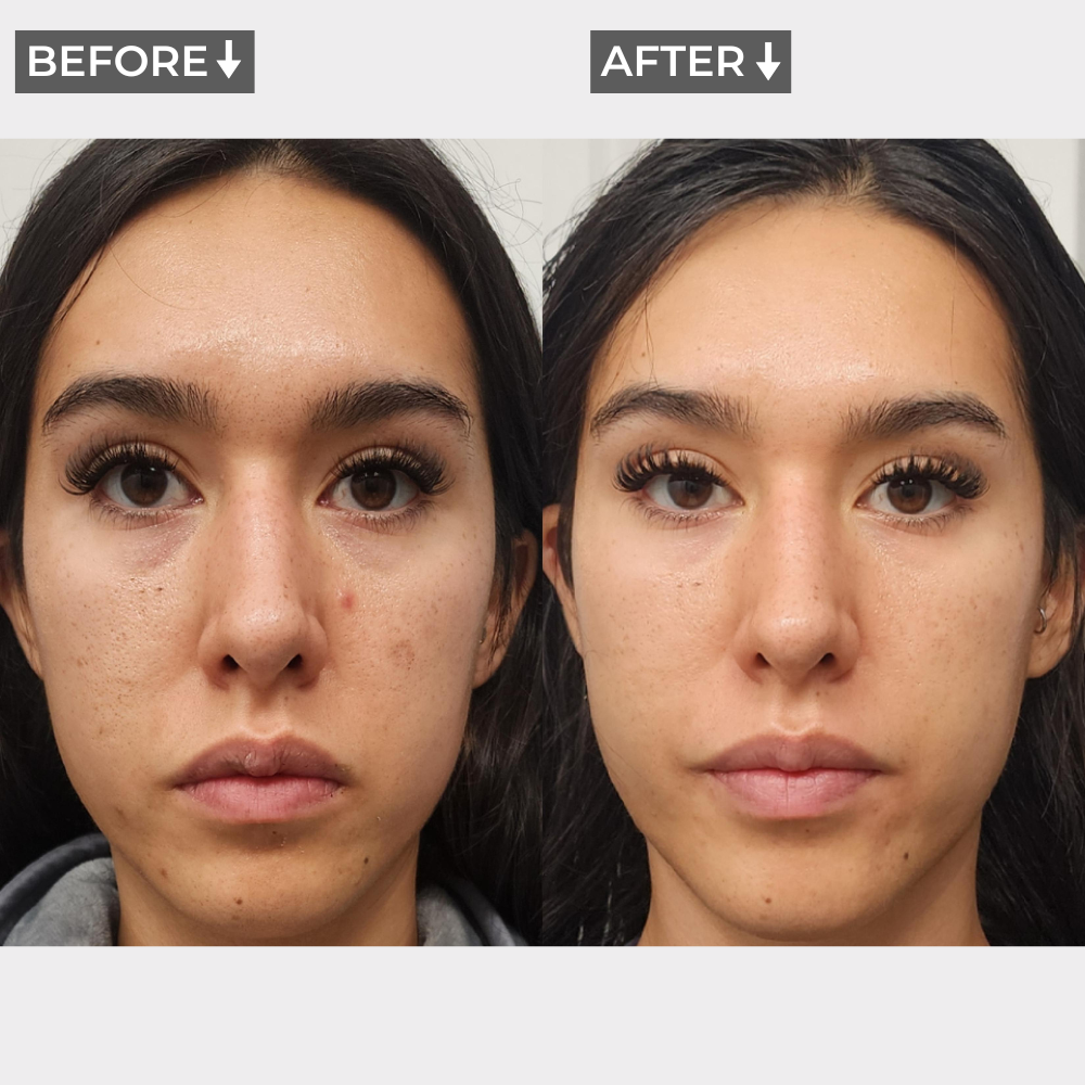AURA+ Nuvibody® LED Masker