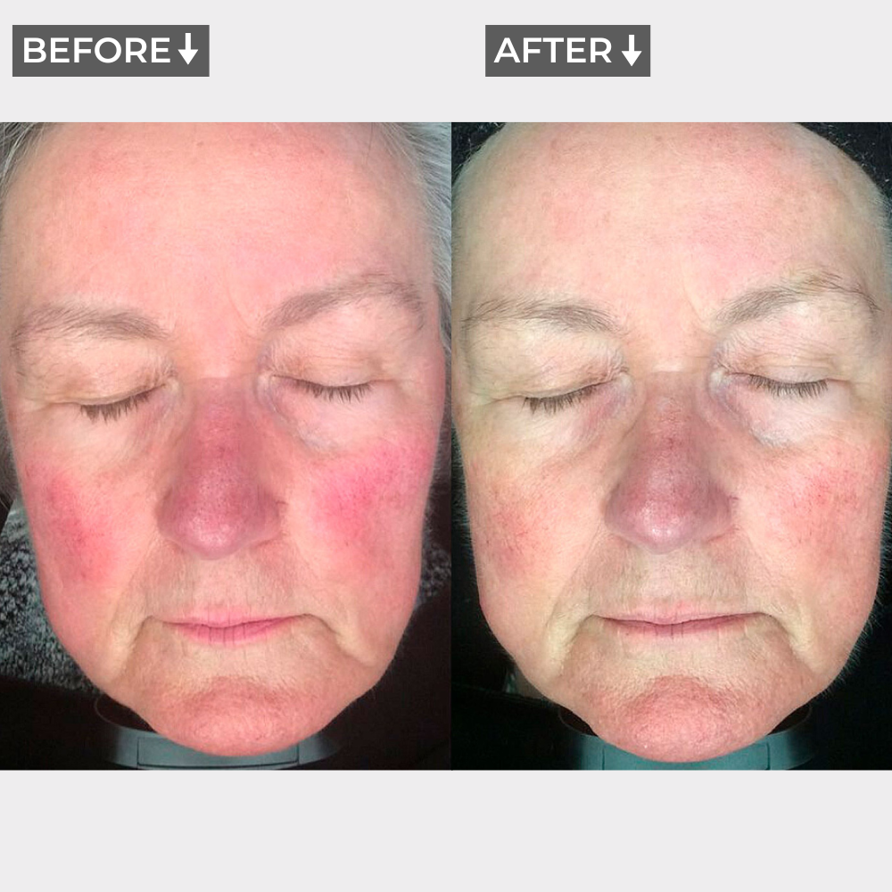 AURA+ Nuvibody® LED Masker